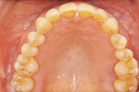 熟年の部１位の歯