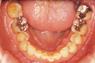 寿年の部１位の歯